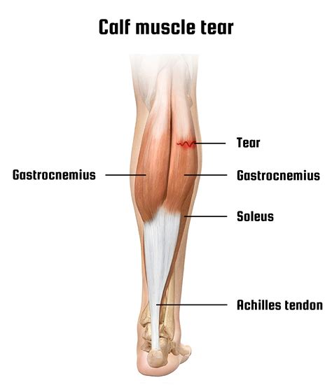 Gastrocnemius Tear: Calf Strain - Dr. Justin Dean