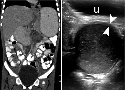 Fig. 15.9, [Duplication cysts represent closed congenital ...