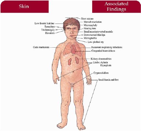 Disorders with Short Stature | Plastic Surgery Key