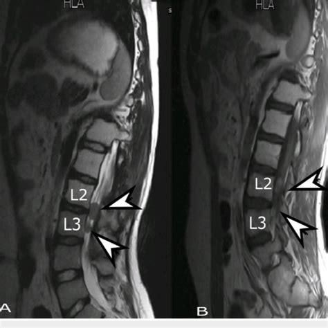 MRI whole spine, sagittal view. (A) T2 weighted and (B) T1 weighted ...