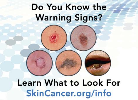 5 Signs Of Skin Cancer