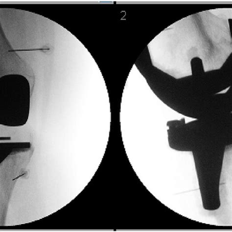 Fluoroscopic images taken during the genicular neurolysis procedure ...