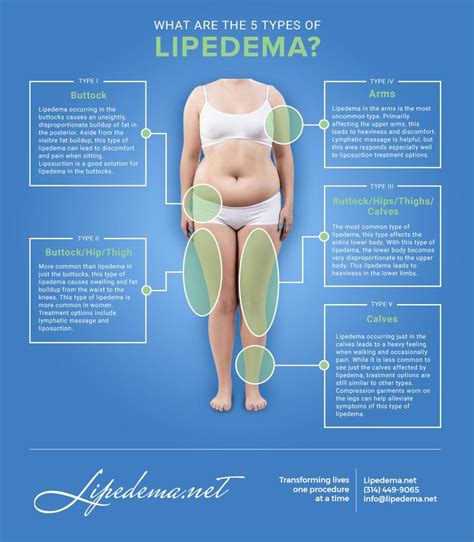 Lipedema (also known as Lipoedema or Lipodema) is a pernicious disease ...