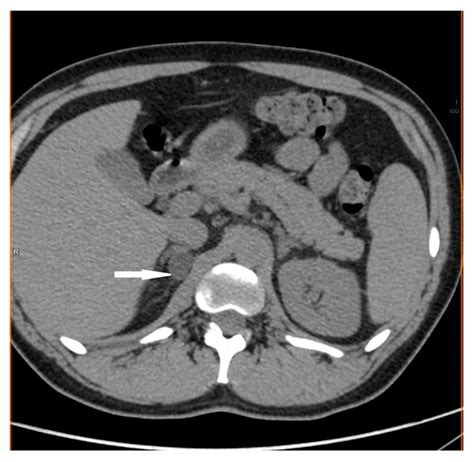 Medicina | Free Full-Text | Adrenal Tumors in Young Adults: Case ...