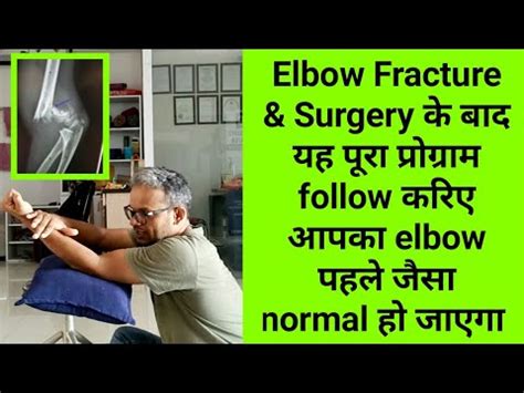 elbow fracture & surgery physiotherapy exercises - complete ...