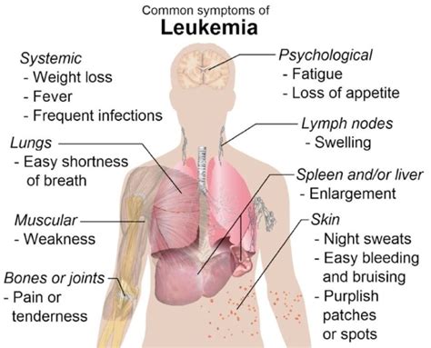 Leukemia: Types, Symptoms, Treatments | Disabled World