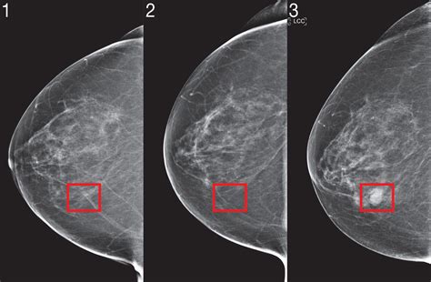 Breast Cancer Digital Mammogram