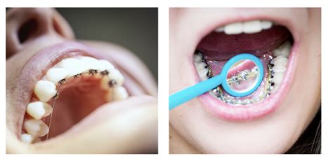 What Are Lingual Braces? (A Complete Guide) - Tisseront Orthodontics