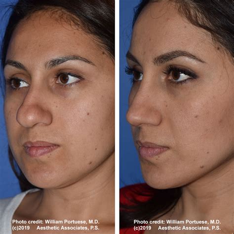 Bulbous Nose Rhinoplasty / Boxy Bulbous Tip | Photos