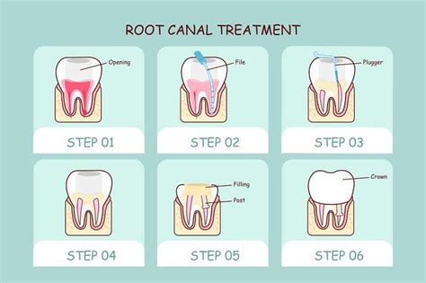 Step by Step Explanation of Root Canal Treatment Procedure - Family ...