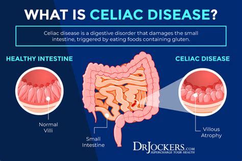 Celiac Disease: Symptoms, Causes and Natural Support Strategies