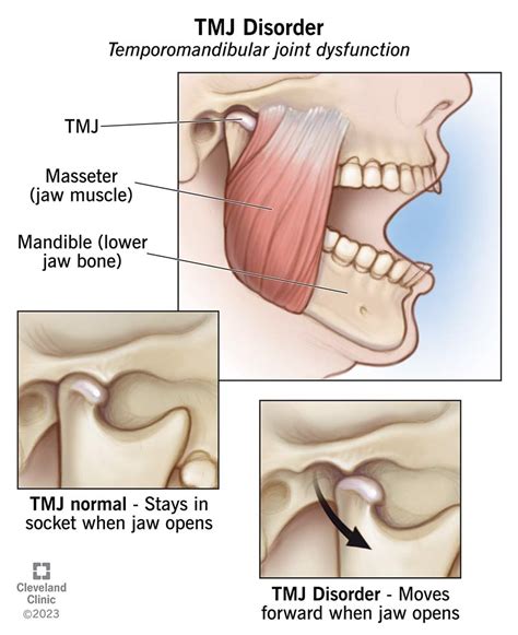 TMJ Disorders: Symptoms, Causes & Treatment