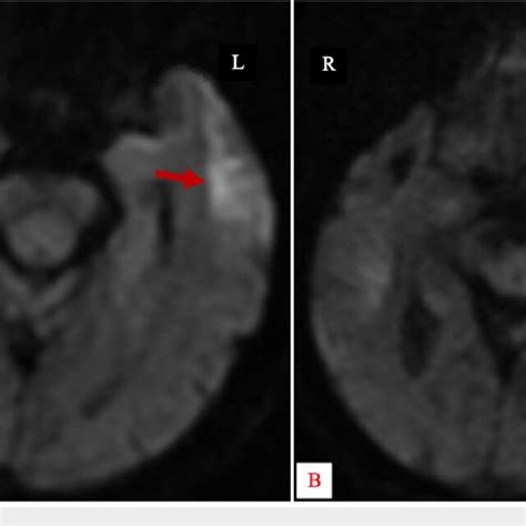 Axial Non-Contrast Diffusion Weighted MR Image of the Brain Restricted ...