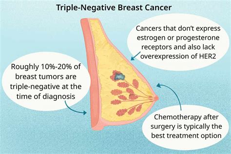 Triple Negative Breast Cancer 5-Year Survival Rate, 60% OFF