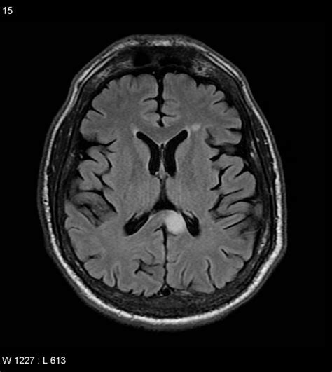 MRI-scan, axial FLAIR show: multiple flair hyperintense lesions in the ...