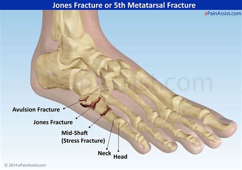 Hairline Fracture In Foot Pictures - Gerald Hipple Coiffure