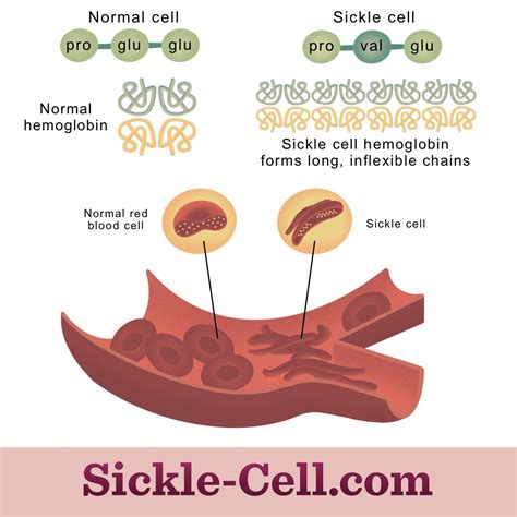 Sickle Cell Anemia Mutation