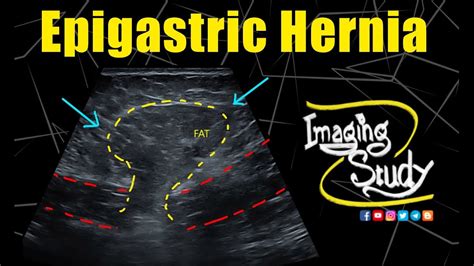 Midline Epigastric Hernia || Ultrasound || Case 320 - YouTube