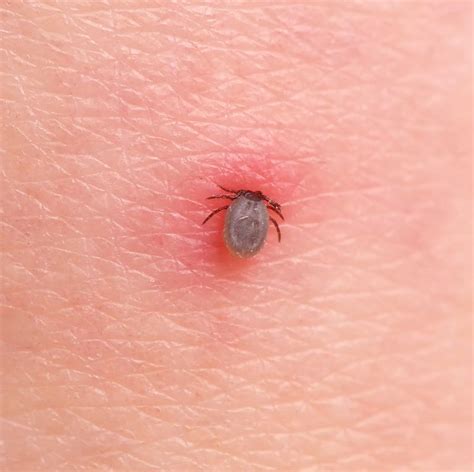 How to Treat a Tick Bite the Right Way, According to Dermatologists in ...