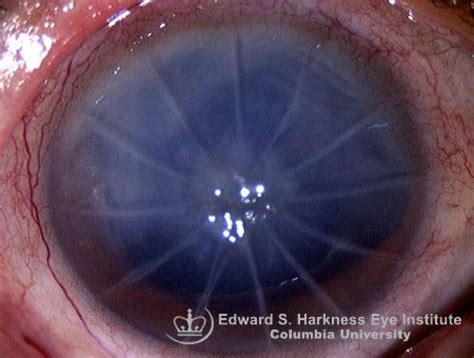 Radial Keratotomy Complication | Vagelos College of Physicians and Surgeons