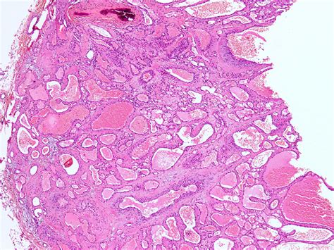 Skin Hemangioma Histology