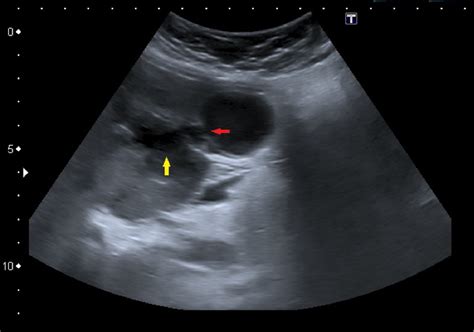 Figure 16 from Gallbladder perforation - radiological aspects, types ...