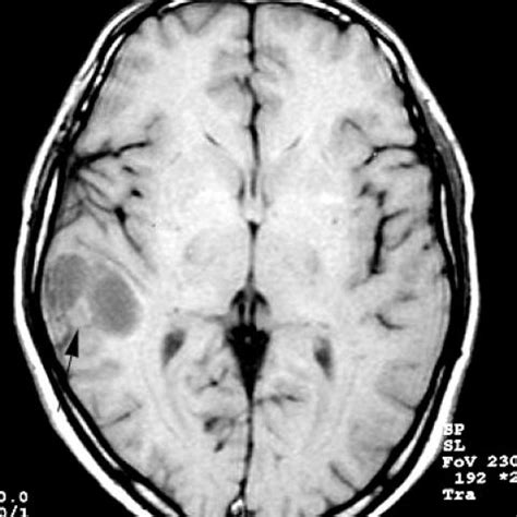 Pleomorphic xanthoastrocytoma | Eurorad