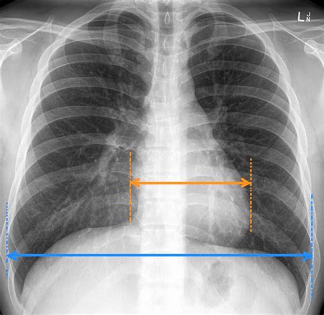 CARDIOMEGALY: ENLARGEMENT OF THE HEART | by Kashaf Shehzad | Jun, 2020 ...