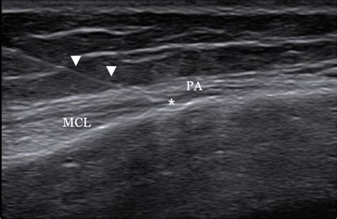 Pes Anserine Ultrasound