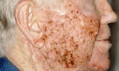 Actinic Keratosis Treatment & Management: Approach Considerations ...