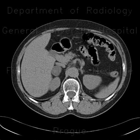 Radiology case: Adrenal adenoma, 3-phase CT