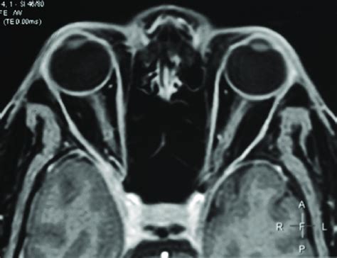 Presentation with headache and right-sided sixth nerve palsy. Axial ...