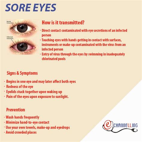 Know about the spread of sore eyes! | SLTMobitel | Scoopnest