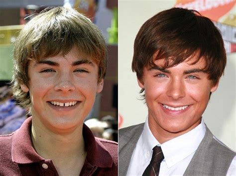 Zac Efron back in the day. Teeth improvement! #celebritydentistry # ...