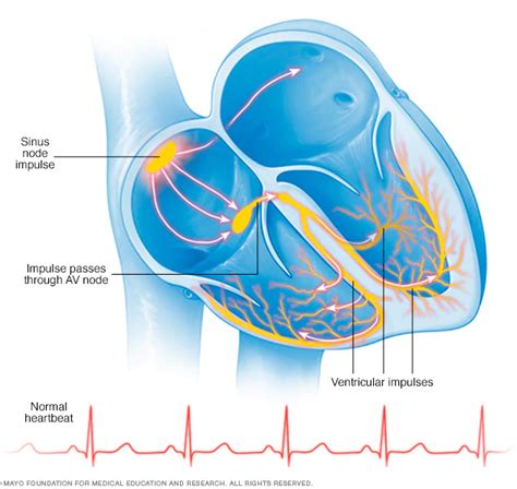 Arritmia Cardiaca