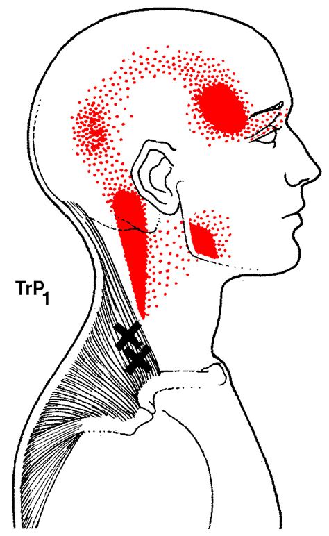 trigger point therapy salt lake city Archives - Free Bodied