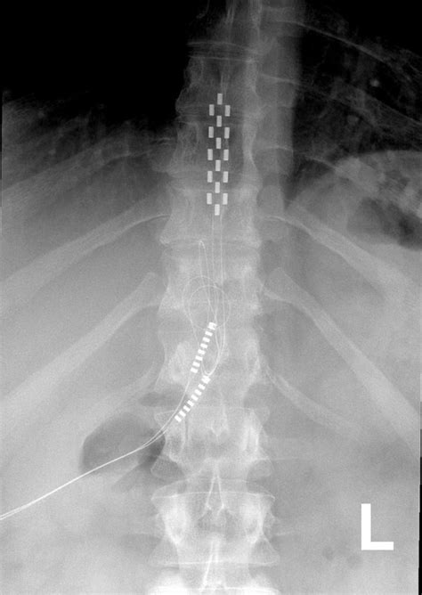 Intractable Pain | Electrical Nerve Stimulation | Spine Institute ...