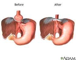 hiatal hernia surgery | hiatal hernia surgery recovery diet | Hernia ...