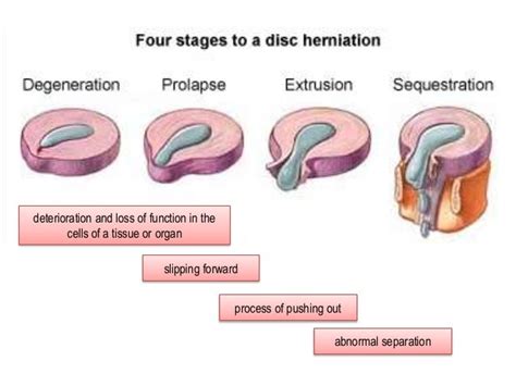 Herniated Nucleus Pulposus