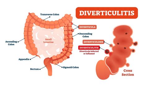 Diverticulitis Cartoon