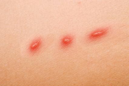 Cat Scratch Fever Symptoms and Treatment | LoveToKnow