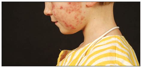 Leukemia cutis: an unusual rash in a child | CMAJ