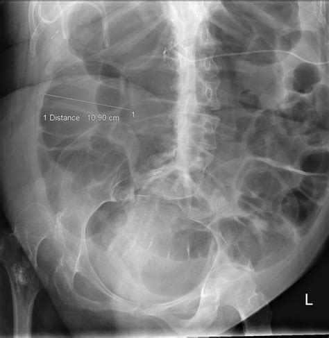 Paralytic ileus - Radiology at St. Vincent's University Hospital