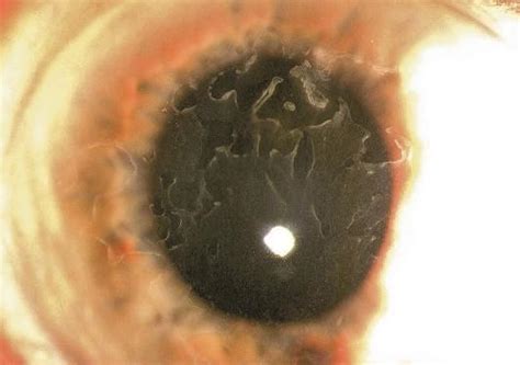 Epithelial Membrane Dystrophy (EBMD) - Lakewood, NJ: InVision Eye Care