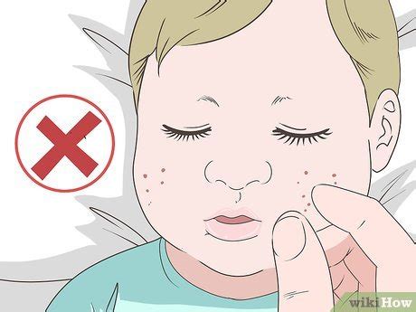 3 Ways to Get Rid of Baby Acne - wikiHow Life