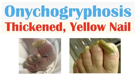 Onychogryphosis (Thickened, Yellow Nails) | Causes, Signs & Symptoms ...