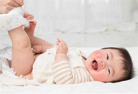 Diaper Rash: How To Cure & Avoid It?