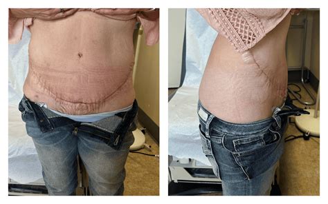 Before & After Tummy Tuck/Panniculectomy Photos - Nevada Surgical