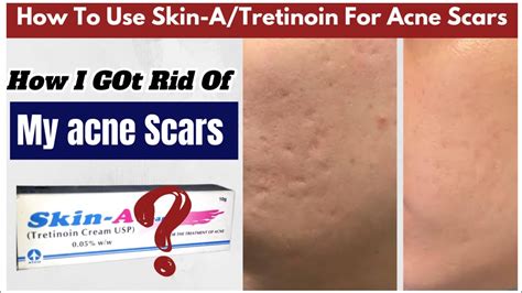 Does Tretinoin/ Skin-A Actually Treat Your Acne Scars ? - YouTube