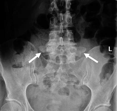 Vértebras de Transição - Clínica Dr. Hong Jin Pai - Dor, Fisiatria e ...